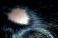 Alopecia areata