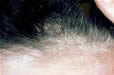 seborrhoeic dermatitis